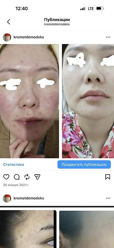 Крем для лица «4 в 1» от demodex (демодекоз, акне, воспаления