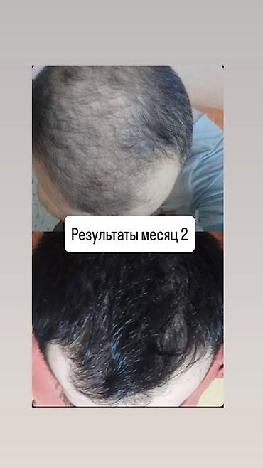 алопеция: Миноксидил Kirkland Signature — средство для стимуляции роста волос — 2