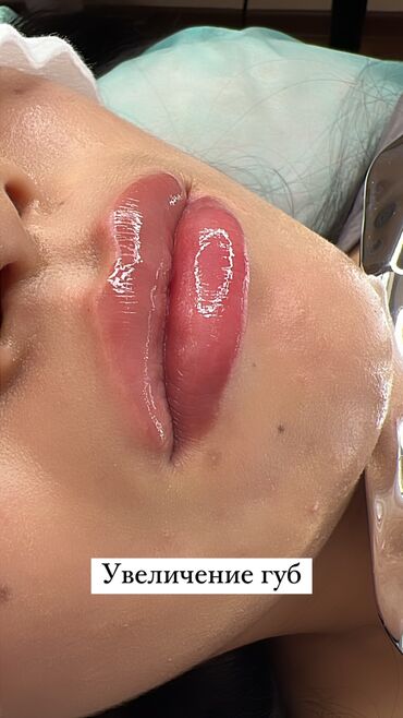 Косметология: Косметология, Ботокс, Биоревитализация, Ботулинотерапия, Консультация, Гипоаллергенные материалы, Сертифицированный косметолог — 30