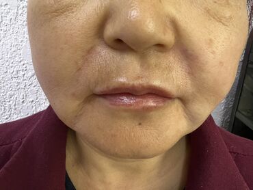 Косметология: Косметология, Ботокс, Биоревитализация, Ботулинотерапия, Консультация, Гипоаллергенные материалы, Сертифицированный косметолог — 25