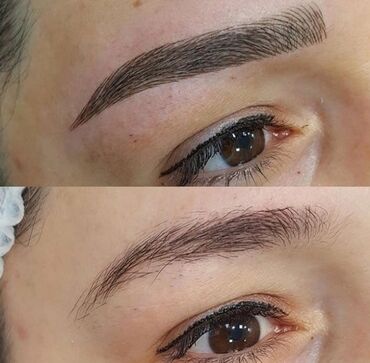 Kirpiklər, qaşlar: Seyrek formasiz qaslarin mikrobledinqle berpasi — 5