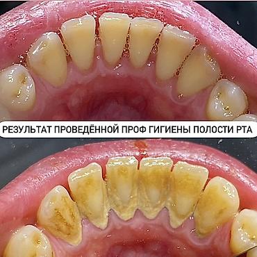 Красота и здоровье: Профессиональная гигиена полости рта (чистка зубов) Что входит: - — 8
