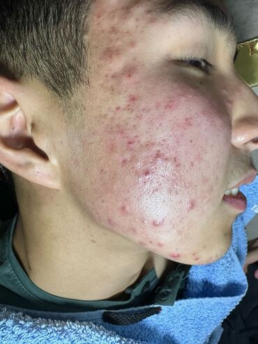 что подарить на день рождения: Косметология, Демодекоз, Лечение угревой болезни, Пилинг, Консультация, Гипоаллергенные материалы, Сертифицированный косметолог