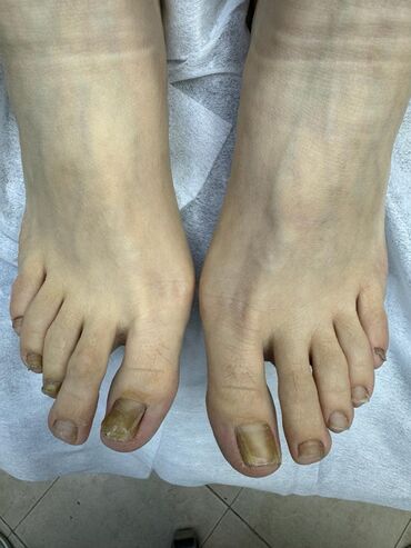 Маникюр, педикюр: Вросший ноготь. Коррекция вросшего сегмента путем удаления врастающих — 6