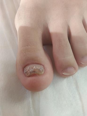 Маникюр: Коррекция вросших ногтей, Педикюр, Услуги подолога, Консультация, Одноразовые расходные материалы — 10