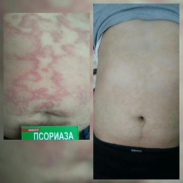 мазь cortam: Здравствуйте! Найден эффективный способ от Псориаза. Я сам болею этой — 6