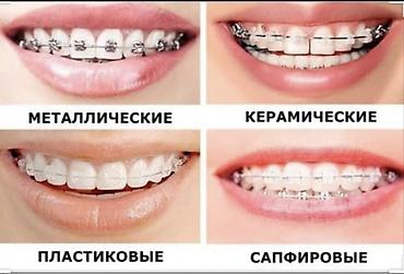 установка брекет: Услуга: установка брекет‑системы на обе челюсти. - Акция: стоимость — 5