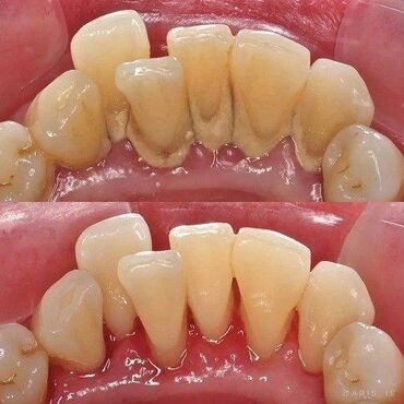 реставрация зуба: Стоматолог | Реставрация, Протезирование, Чистка зубов | Консультация