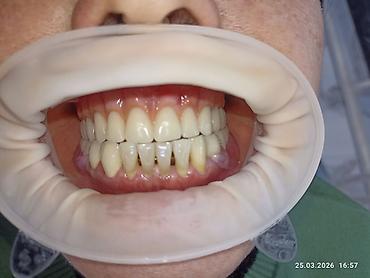 Ортезы: Съемные частичные зубные протезы - Тип: частичные протезы для верхней — 15