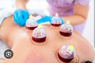 наращивание волос в баку цены: Xəmsə (hijama) – vakuum fincanlarla qan çıxarma terapiyası Xidmət
