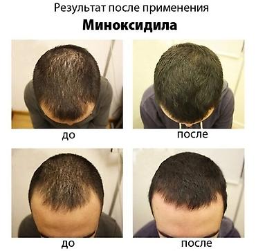 minox: Kirkland Signature Minoxidil 5% Topical Solution, Extra Strength for — 5