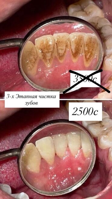 оборудование для химчистки авто: Профессиональная 3‑х этапная чистка зубов Что включено: - Удаление