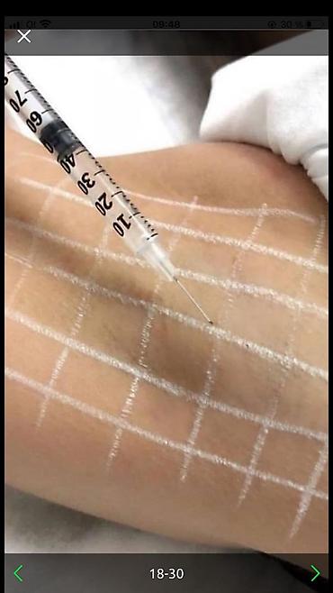 Косметология: Косметология, Ботокс, Биоревитализация, Ботулинотерапия, Консультация, Гипоаллергенные материалы, Сертифицированный косметолог at lalafo.kg — 4 Косметология: Косметология, Ботокс, Биоревитализация, Ботулинотерапия, Консультация, Гипоаллергенные материалы, Сертифицированный косметолог — 4