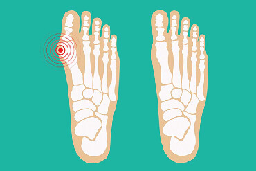 165 объявлений | lalafo.kg: Корректоры для большого пальца ноги от вальгусной деформации(косточки