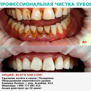 зубные щетки: Профессиональная чистка зубов всего за 500 сом! Удалим налёт, зубной