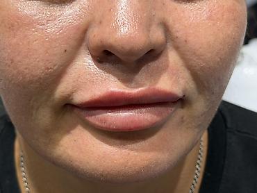 я ищу лобо: Косметология, Ботокс, Консультация — 3