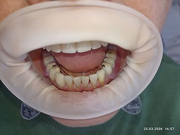 Ортезы: Съемные частичные зубные протезы - Тип: частичные протезы для верхней — 16