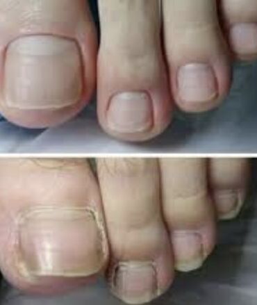 что подарить на день рождения: Ичине кирип өскөн тырмактарды оңдоо, Педикюр, Бир жолку сарпталуучу материалдар