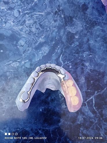 Ортезы: Съемные частичные зубные протезы - Тип: частичные протезы для верхней — 10