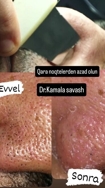ищу сиделку для пожилой женщины: Qara nöqtələrə qarşı peşəkar üz təmizlənməsi Xidmətin mahiyyəti: -