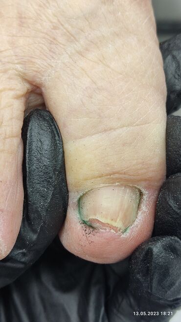 Маникюр, педикюр: Коррекция вросших ногтей, Маникюр, Педикюр, Услуги подолога, Консультация, Одноразовые расходные материалы — 2