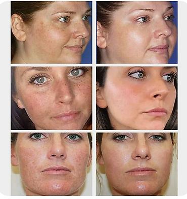 Уход за телом: ❄️ США Крем интенсивное отбеливание с Аmazon и Еbay Крем дает ▶ — 18