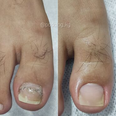 Маникюр, педикюр: Коррекция вросших ногтей, Педикюр, Услуги подолога, Консультация, Одноразовые расходные материалы — 3