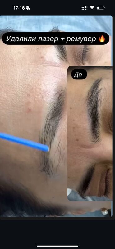 Перманентный макияж: АКЦИЯ !АКЦИЯ! Новый метод удаления Сейчас по акции Лазерное удаление — 3