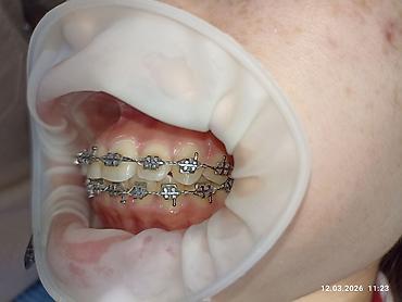 Ортезы: Ортодонтическое лечение: установка брекет‑системы на нижнюю челюсть - — 9