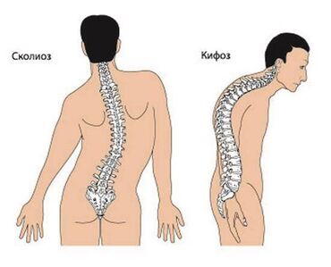 en bahali etirler: Skolioz onurğa fəqeəsininn əyriliyi anlamındadır.Minlərlə insan bu