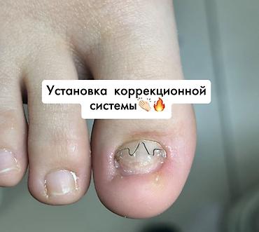 хирург обрезание: Коррекция вросших ногтей, Услуги подолога, Консультация — 1