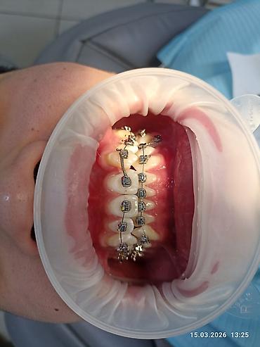 Ортезы: Ортодонтическое лечение: установка брекет‑системы на нижнюю челюсть - — 3