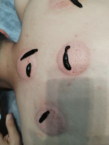 Hicama, zəli: İlk önce masaj hicama, zeli üzre bir mütexessis kimi onu deye bilerem — 6