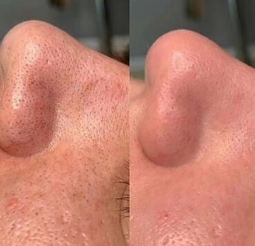 Kosmetologiya: Bəylər üçün = Lazer Epilasiyasi✅Hicama və — 9