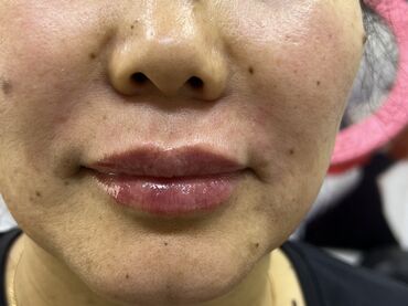 Косметология: Косметология, Маски, Мезотерапия, Удаление носогубных складок, Гипоаллергенные материалы, Консультация, Сертифицированный косметолог — 39