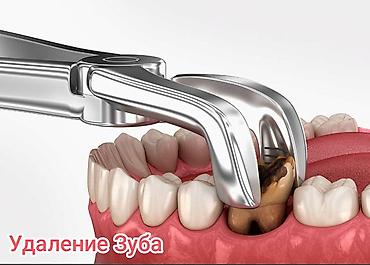 Стоматологи: Съёмные зубные протезы под ваши задачи - Вакуумные протезы: плотная — 19