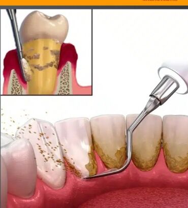 zirkon diş qiyməti: Стоматология