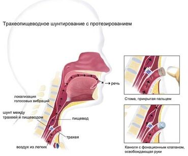 Nitril əlcəklər: Trakeo‑özofageal şunt və səs berpasi. Girtlagi cixarilanlar insanlara