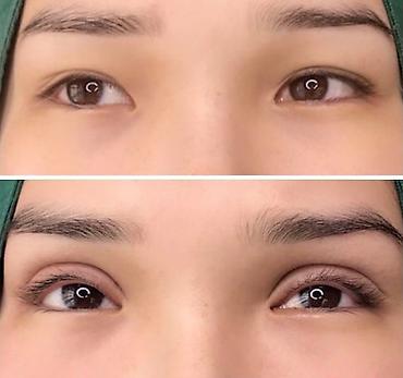 Косметология: Жип менен сурма чыгарабыз, операциясыз, кесилбейт, Оорубайт, шрам — 2