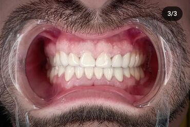 Stomatologiya: 💫Ramazan ayı ilə əlaqədar Kampaniya✨🌟⭐💫 🌊🔥Diş Həkimi 🔥🌊 Qiymətləri — 12