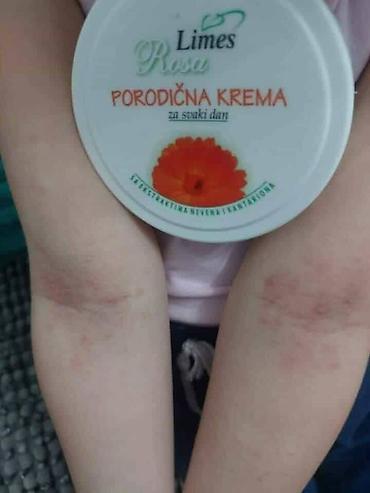 Nega kože: Ide leto,deca su u majicama i sorcicima. Padovi sa — 9