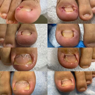 Маникюр, педикюр: Ремонт сломаных ногтей, Снятие, Укрепление ногтей, Услуги подолога, Одноразовые расходные материалы, Консультация, С выездом на дом — 5