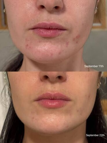 Косметика: 🔥 НАБОР (2шт сыворотки и увлажняющий крем)Reedle Shot Duo Set — — 8