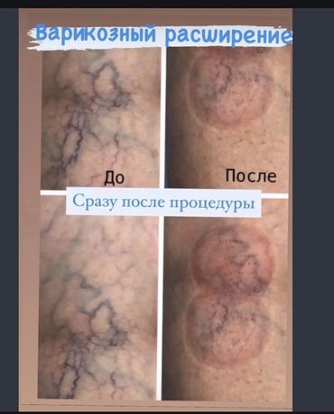 Другие услуги в сфере красоты и здоровья: КАПИЛЯРА ТИРАПИЯ
