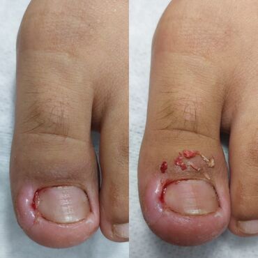 Маникюр, педикюр: Коррекция вросших ногтей, Педикюр, Услуги подолога, Консультация, Одноразовые расходные материалы — 4