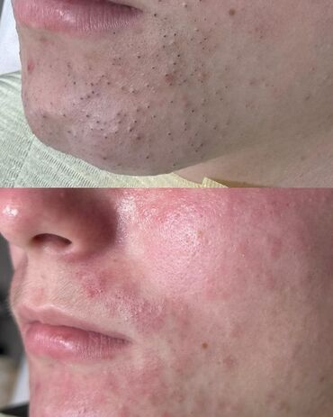 Косметология: Косметология, Пилинг, Ботулинотерапия, Плазмолифтинг, Консультация, Требуются модели, Сертифицированный косметолог — 5