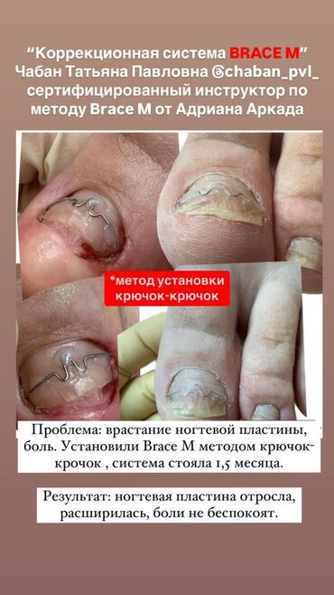 Маникюр, педикюр: Ремонт сломаных ногтей, Снятие, Укрепление ногтей, Услуги подолога, Одноразовые расходные материалы, Консультация, С выездом на дом — 8