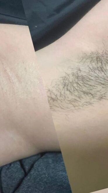 Эпиляция: Шугаринг (депиляция сахарной пастой) Зоны: - Подмышки - Ноги (голени) — 3