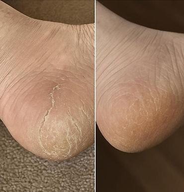 pedikür: Ev şəraitində ayaq baxımı, aparatla, sulu, scrabla, parafinlə daban — 3