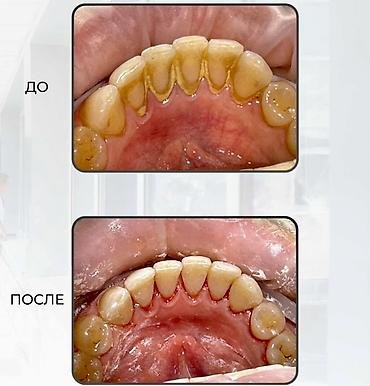 Красота и здоровье: Профессиональная гигиена полости рта (чистка зубов) Что входит: - — 3
